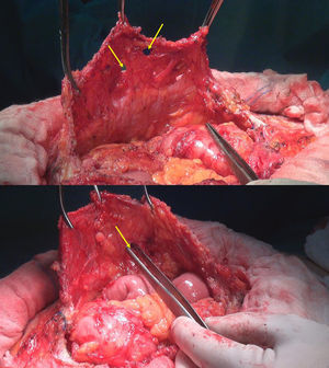 Detalle operatorio de la pared a los 8meses de la implantación de una malla biológica. Véanse los múltiples defectos entre los tractos conectivos, insuficientes para contener las asas intestinales.
