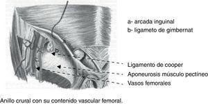Anillo crural y ligamento de Gimbernat.