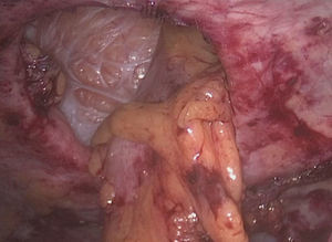 Visión laparoscópica de una hernia paraestomal tras reducir su contenido.