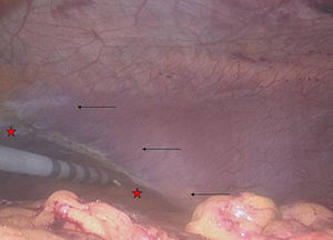 Preparación de los límites óseos del hemiabdomen afecto. Lesión térmica del peritoneo sobre el margen costal (límite superior). (Flechas: reborde costal; estrellas: peritoneo dañado).