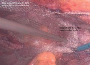 Colocación de la hoja superior solapando la inferior y tunelizando el asa de colostomía.