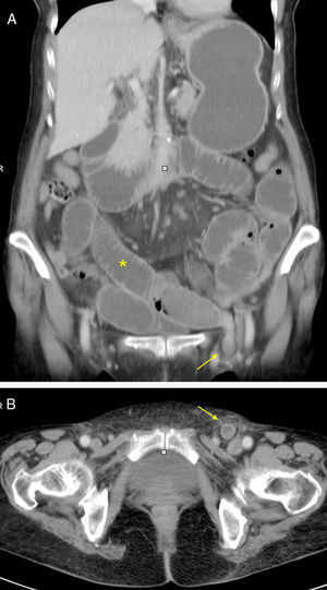 A) y B). Imagen coronal y transversal de TCMD que muestra una oclusión intestinal (*) provocada por un asa de íleon incarcerada en una hernia inguinal (flechas).