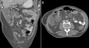 A y B) Imagen coronal y transversal de TCMD en paciente con sospecha de hernia de Spiegel. Las imágenes demuestran un gran lipoma (*) entre los oblicuos interno y externo que simula una herniación abdominal.