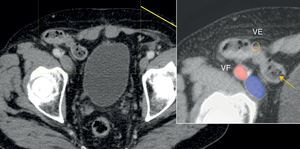 Imagen transversa de TCMD que muestra una hernia inguinal indirecta. Las hernias indirectas presentan su orificio herniario en el anillo inguinal, localizado lateral a los vasos epigástricos. El saco puede extenderse hasta el escroto o los labios mayores, por el interior del conducto inguinal. En la imagen se observa la herniación de un asa intestinal de íleon (flecha) a través del anillo inguinal. VE: vasos epigástricos; VF: vasos femorales.