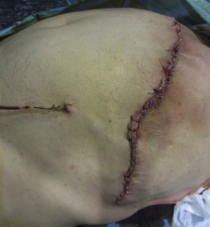 Cicatriz final tras la reparación de una hernia subcostal masiva. Pared abdominal sin abultamiento.