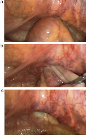 (a) Visión laparoscópica de herniación de íleon por orificio obturador. 2(b) Reducción de contenido herniario con pinzas atraumáticas. 2(c) Orificio obturador y líquido ascítico.