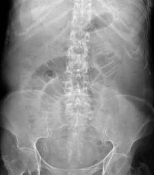 Radiografía de abdomen. Signos radiográficos de obstrucción intestinal con dilatación de asas de intestino delgado.