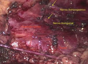Identificación del nervio genitofemoral sobre el músculo psoas. Las flechas indican los nervios.
