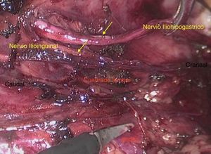 Sección de los nervios con tijeras tras disecar unos 4cm. Las flechas indican los nervios.