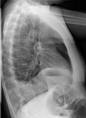 Radiografía de tórax lateral izquierda, en la que se aprecia elevación del hemidiafragma y presencia de contenido intestinal en la cavidad torácica.