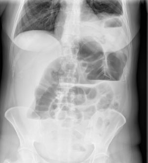 Radiografía simple de abdomen, en la que se aprecia elevación del hemidiafragma izquierdo con contenido intestinal en la cavidad torácica y dilatación de colon hasta el ángulo esplénico.