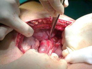 Detalle operatorio del orificio herniario diafragmático con colon transverso incarcerado.