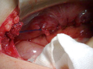 Detalle operatorio del cierre del orificio herniario con sutura continua de polipropileno 0.