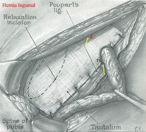 Hernioplastia inguinal personal del Dr. Koontz. Se muestra: (1) la sección de la hoja inferior de la malla y (2) la ausencia de fijación del borde superior y laterales de esta.