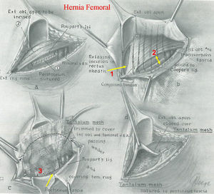 Hernioplastia femoral según el Dr. Koontz. Se muestra: (1) la incisión de relajación sobre la vaina del músculo recto; (2) la sutura del tendón conjunto al ligamento de Poupart, y (3) el refuerzo con una malla fijada solo al borde inferior, fascia pectínea y ligamento de Cooper.