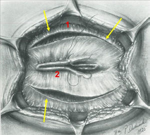 Reparación de la hernia umbilical del adulto según la técnica de Stone. Se muestran los pilares que predominan en las intervenciones de pared abdominal del Dr. Koontz: (1) el uso de incisiones de relajación sobre la zona central de la vaina del músculo recto; (2) una sutura isotensional que oculta la primera sutura (eliminando las zonas débiles laterales de la técnica de Mayo), y el refuerzo con malla solo en las hernias secundarias (para las primarias, como en este caso, aconsejaba una técnica de reparación anatómica).