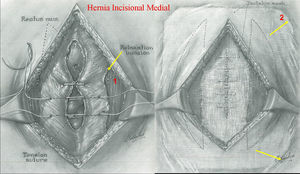 Hernioplastia incisional donde se destaca: (1) la gran incisión lateral de relajación sobre la vaina del músculo recto abdominal, y (2) el refuerzo de toda el área premuscular disecada.