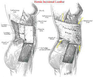 Hernioplastia lumbar. El autor usa una malla superficial del mayor tamaño posible, abarcando toda la hemipared abdominal lateral entre sus límites óseos (flechas).