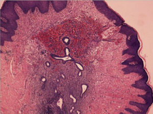 Estudio anatomopatológico. Estudio microscópico: presencia en la dermis de glándulas endometriales rodeadas de estroma. 100× (hematoxilina-eosina).