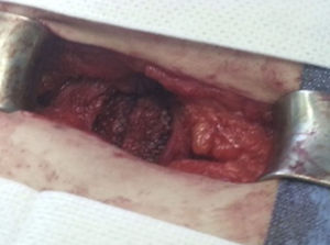 Procedimiento quirúrgico. Cierre del defecto fascial con malla Ultrapro® de 6×9cm.