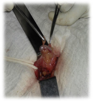 Apéndice cecal no inflamado en el saco de hernia inguinal incarcerada. Puede verse el cordón inguinal jalonado, la hernia y su contenido.