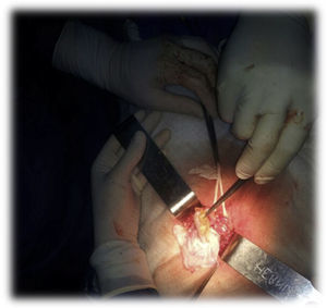 Apéndice cecal en saco de hernia inguinal incarcerada. Puede verse el cordón inguinal jalonado y el apéndice cecal no inflamado aislado por una gasa del resto del lecho quirúrgico.