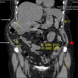 Valoración tomográfica del resultado posoperatorio, según la cuantificación del eje costoilíaco y del contenido visceral. La estrella roja indica el defecto lumbar.