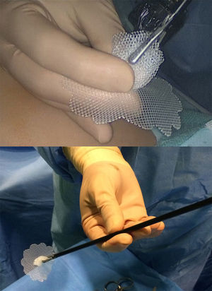 Forma de sujetar la malla doblando los pétalos (arriba) y montada sobre una pinza de laparoscopia (abajo).