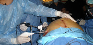 Ejecución de eventroplastia laparoscópica durante el componente de cirugías en vivo con transmisión interactiva al auditorio.