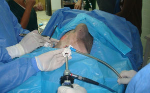 Evidencia de hernia incisional inducida en un cerdo.