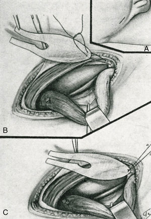 Técnica Zagdoun: Fijación de la placa a la espina del pubis. Tomada de su trabajo original en 1959.