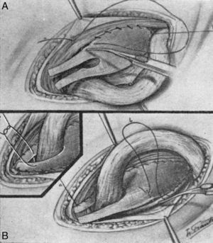 Técnica Zagdoun: Fijación de la placa al ligamento inguinal, al tendón conjunto y cierre de las dos lengüetas, ajustando «la corbata» al cordón para cerrar al máximo el paso por el orificio inguinal profundo. Tomada de su trabajo original en 1959.