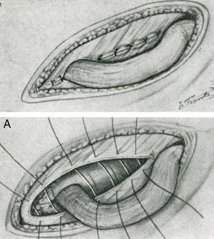 Técnica Zagdoun: Plano de sutura de la aponeurosis del oblicuo mayor para cubrir la placa. Tomada de su trabajo original en 1959.