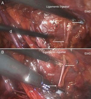 Abordaje laparoscópico. Visión del nervio femorocutáneo lateral. A (superior): localización del nervio sobre el músculo ilíaco. B (inferior): neurectomía. ce: cordón espermático; d: deferente; EIAS: espina ilíaca anterosuperior.