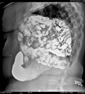 Estudio radiológico con tránsito intestinal baritado. Se observa el gran volumen herniado de intestino delgado y grueso hacia la cavidad torácica derecha.