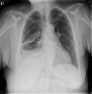 Radiografía de tórax (posoperatorio inmediato).