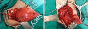 A: Hernia directa con un gran saco que contiene la vejiga. Cordón espermático (flecha). B: Reparación con malla de polipropileno según la técnica de Celdrán.