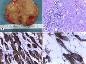 A. Lipoma de pared (aspecto macroscópico). B. Tumor de células granulares benigno, hematoxilina y eosina (HyE) (40x). C. Tinción inmunohistoquímica (IHQ) positiva +++ para S100 en tumor de células granulares (40x). D. CD56 intensamente positivo en tumor de células granulares (40x).