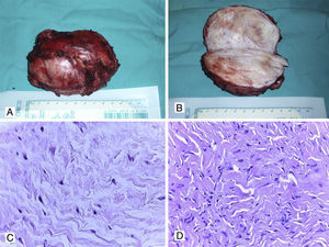 A, B. Tumor desmoide de pared abdominal (aspecto macroscópico). C, D. Aspecto histopatológico con HyE de fibromatosis de pared abdominal (40x).