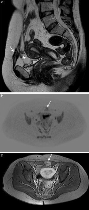 Endometriosis de pared abdominal anterior en mujer de 38 años con antecedente de cesárea. La imagen de RM sagital potenciada en T2 (a) muestra una masa de bordes irregulares y espiculados en la cicatriz quirúrgica de la pared abdominal anterior izquierda (flecha), de baja señal y heterogénea, con pequeños focos hiperintensos en su interior, asociando bandas hipointensas en la grasa prevesical adyacente correspondientes a adherencias fibrosas (cabeza de flecha). Presenta restricción en la imagen de difusión (b) y captación intensa en la imagen potenciada en T1 tras la administración de contraste intravenoso (c).