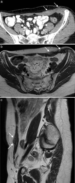 Metástasis en pared abdominal por diseminación directa en el sitio de los puertos de cirugía laparoscópica de carcinoma mucinoso de ovario en una mujer de 57 años. La TC (a) con contraste intravenoso y oral muestra una tumoración mal delimitada en la musculatura de la pared abdominal anteroinferior izquierda, en el sitio de entrada del trocar de laparoscopia. Las imágenes de RM potenciadas en T2 en el plano axial (b) y sagital (c) definen con mayor precisión la tumoración, que presenta una señal heterogénea.
