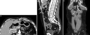 Esplenosis en pared abdominal anterior en paciente de 63 años con antecedente de esplenectomía. La TC con contraste intravenoso en fase portal (a) con reformateo sagital (b) y coronal (c) muestra el conglomerado de implantes de esplenosis en la musculatura y el espacio preperitoneal de la pared abdominal anterior, de bordes lobulados y bien definidos, con captación homogénea de contraste (flechas).