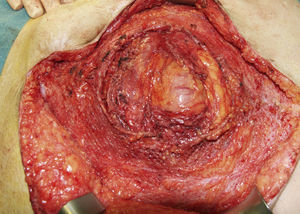 Imagen intraoperatoria del segundo caso, que muestra el defecto herniario completamente rodeado por la malla.