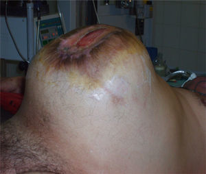 Gran distensión abdominal. Lesiones tróficas en la cicatriz quirúrgica.