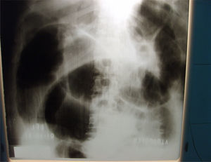 Radiografía de abdomen. Gran nivel hidroaéreo. Signo del borde en tiralíneas de Ferreyra.