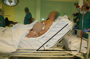 Posición del paciente tras la disección del plano muscular, durante la reparación y en el posoperatorio.