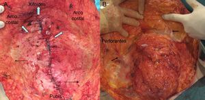 A. Recomendación de limitar la disección suprafascial medial del abdomen para preservar la vascularización. Los límites superior (xifoides) y lateral (arco costal) deben respetarse, pero el lumbar debe evitarse en lo posible (flechas). B. Localización de las perforantes de gran calibre (flechas).