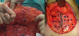 Fijación del colgajo de la abdominoplastia. A. Punto de Baroudi para fijar el colgajo. B. Mapeo para el diseño de los puntos de fijación.