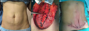 Escenario I. A. Mujer con exceso de piel infraumbilical y pequeña hernia umbilical. B. Disección de la pared y orificio herniario. C. Miniabdominoplastia extendida sin incisión periumbilical.