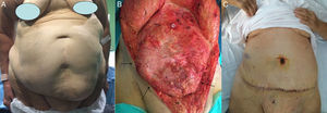 Escenario II. Mujer de 78 años con cirugía ginecológica. A. Enorme defecto medial e infraumbilical que deforma y altera la mecánica funcional de la pared abdominal. B. Se muestra el contenido visceral evidente inmediatamente bajo el peritoneo tras levantar el colgajo dermograso hasta el xifoides (flechas negras). C. Situación de la paciente al alta hospitalaria (al tercer día) tras abdominoplastia clásica.